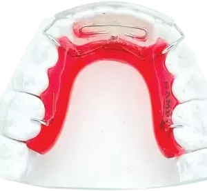 Lower Modified Spring Retainer Plus with Occlusal Rest