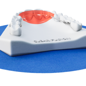 Fixed 6-6 Lingual Anterior Bite Plate