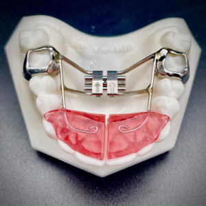 Hyrax Leone RPE w Anterior Bite Plate