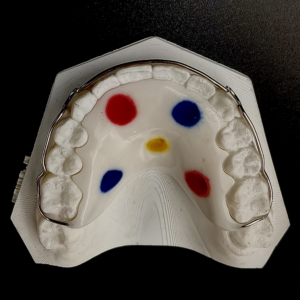 Maxillary Full Labial With Adams Clasps