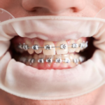 Spring Retainers