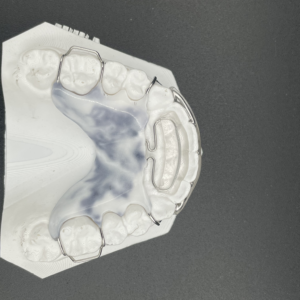 Maxillary Modified Spring Retainer Plus with Adams - Image 3