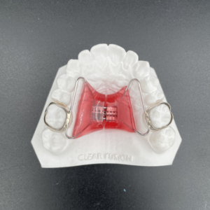 Haas Palatal Expander